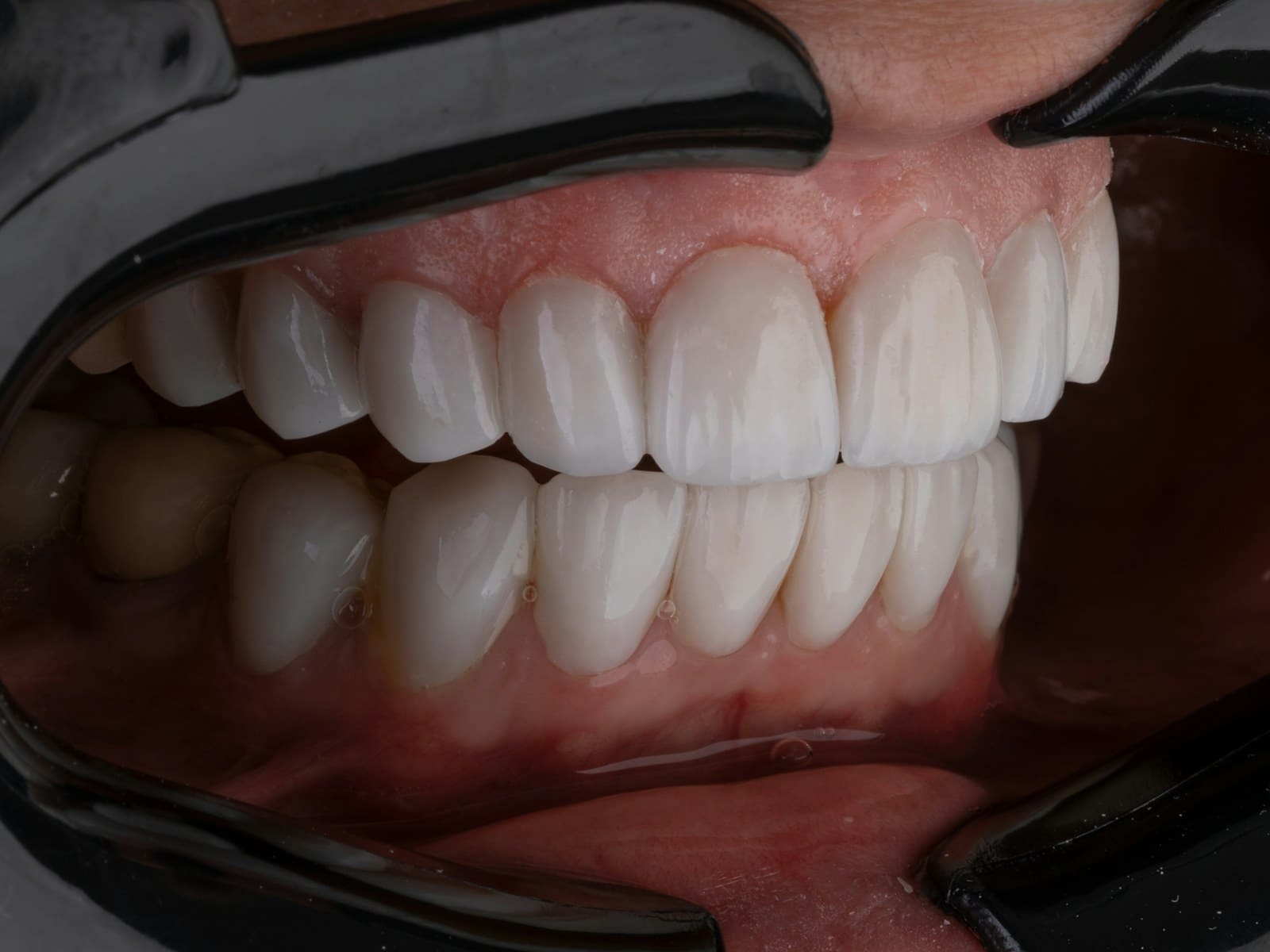 Full Smile Treatment — clinical photograph taken before treatment