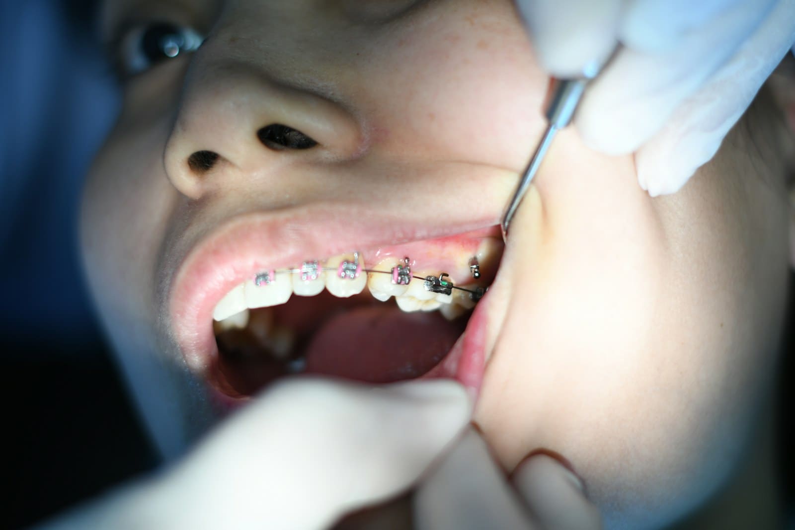 Dental Braces treatment at OK Dental Care Muzaffarpur