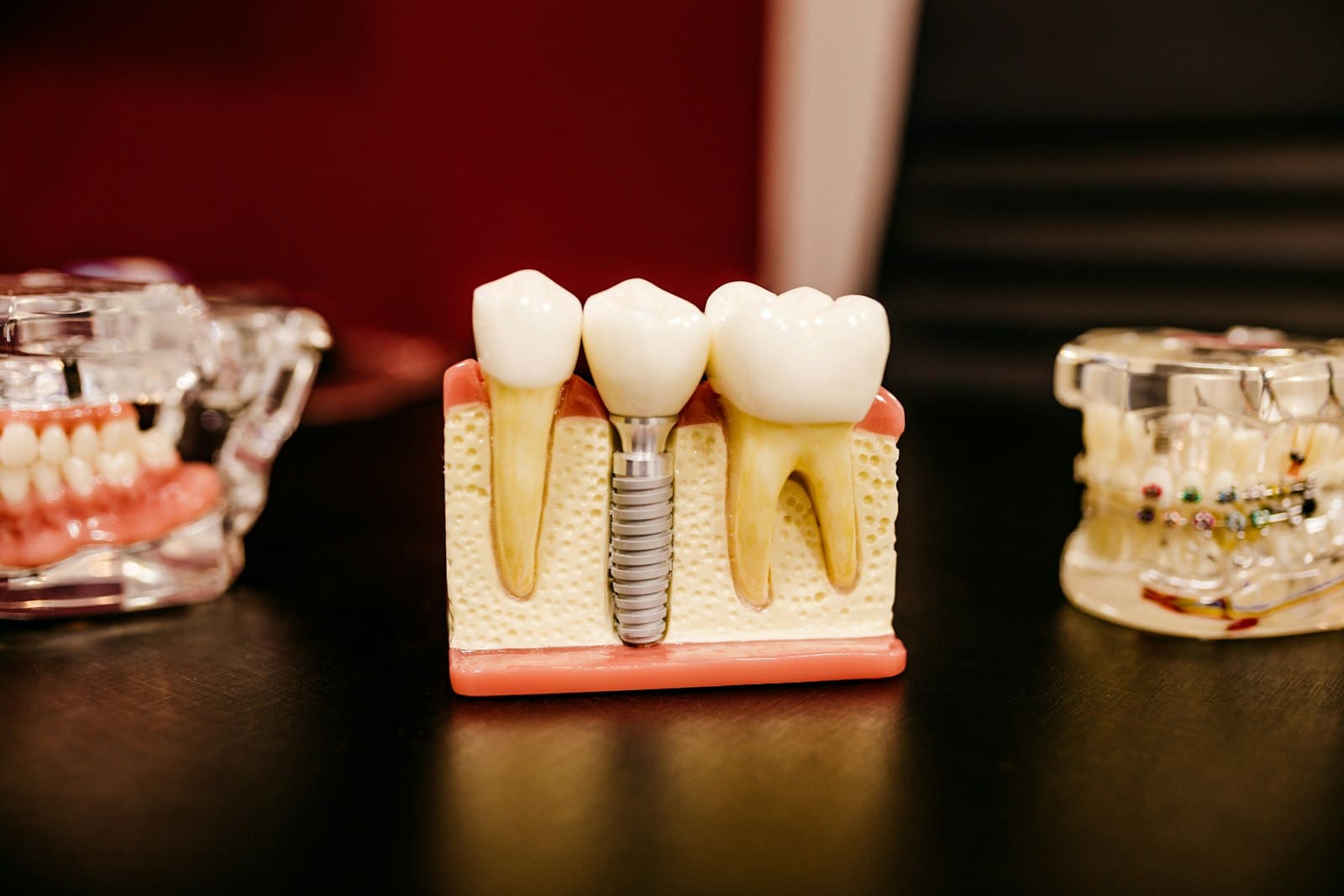 Dental Implants treatment at OK Dental Care Muzaffarpur