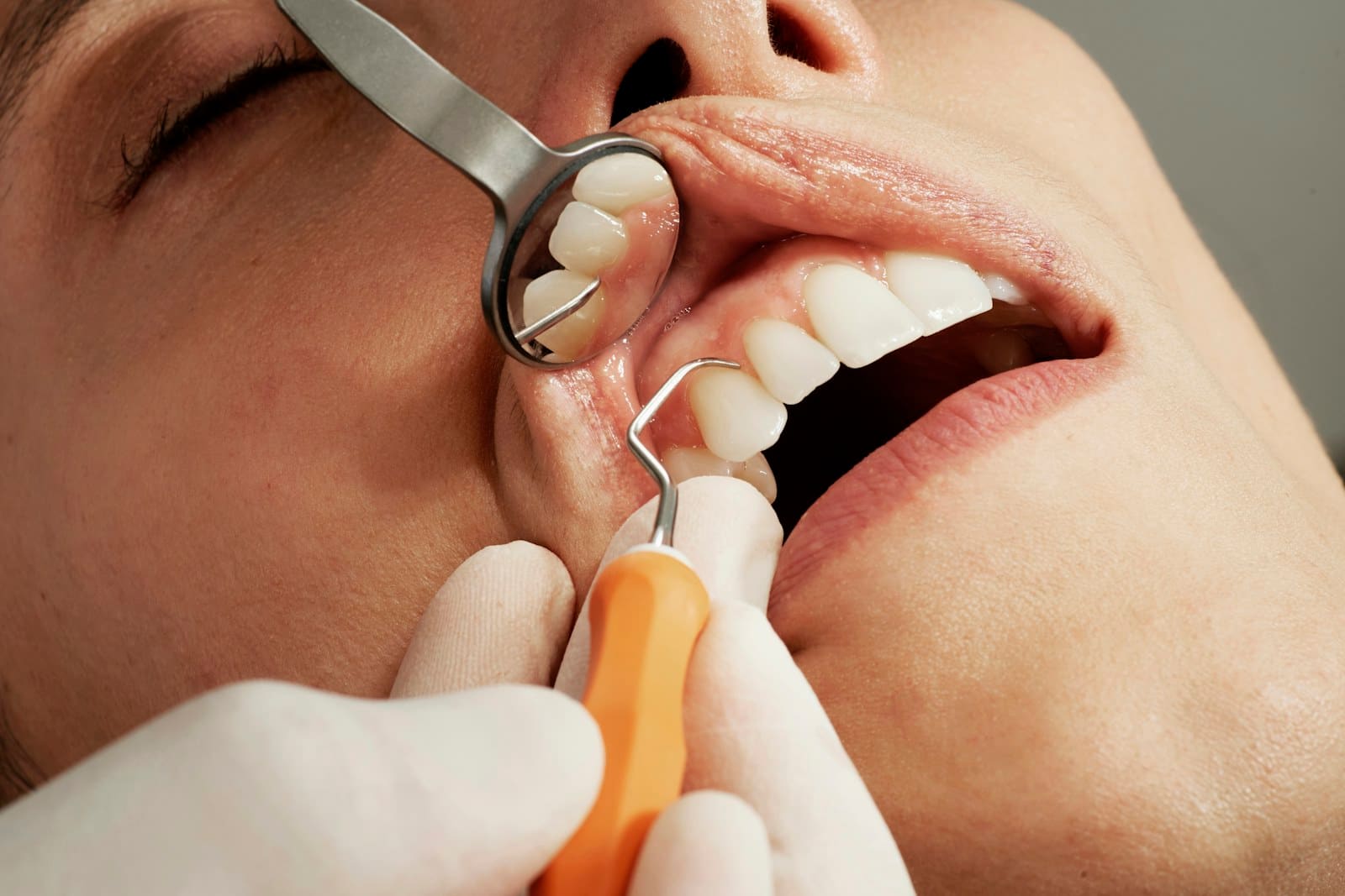 Root Canal treatment at OK Dental Care Muzaffarpur