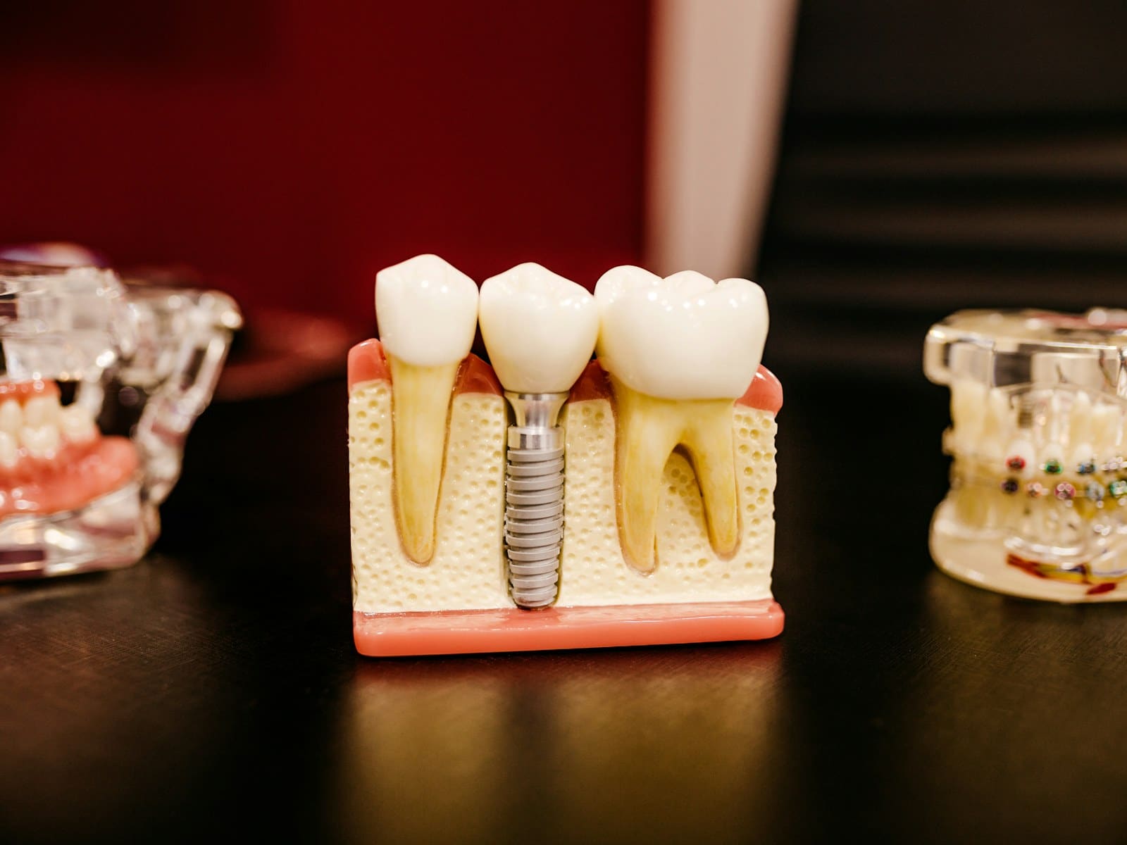 A dental implant model shown alongside its planning scan on a clinic monitor